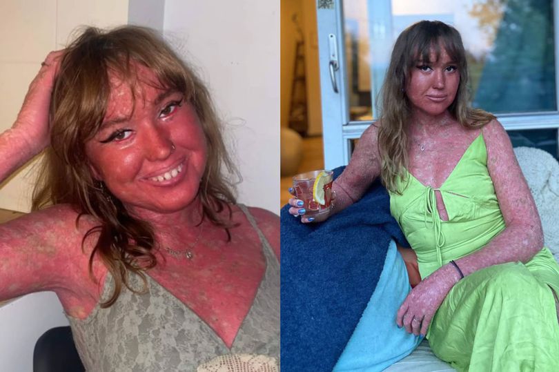 My peeling, growing skin makes me feel unique despite being called a monster